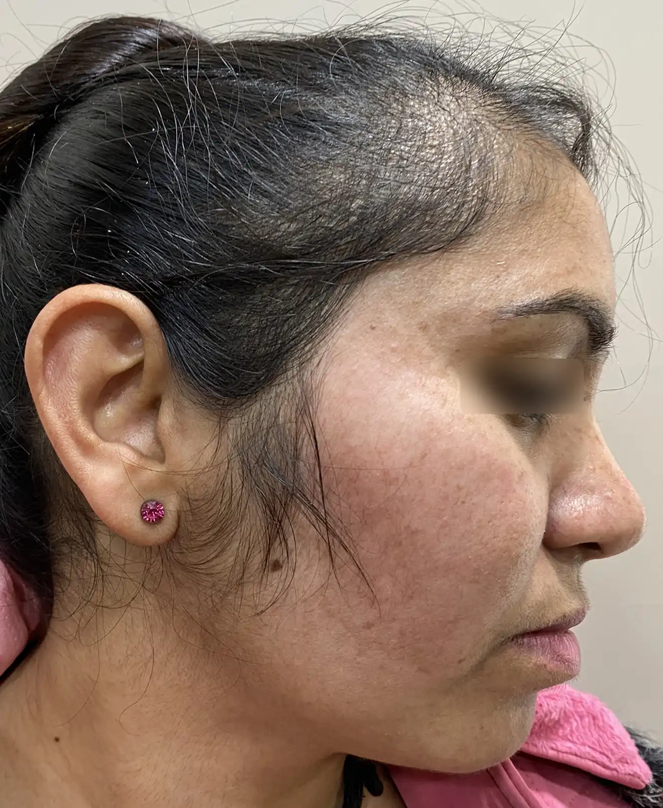 Female melasma patient after treatment showing visible lightening of facial pigmentation and improved even skin tone on cheeks and temples.