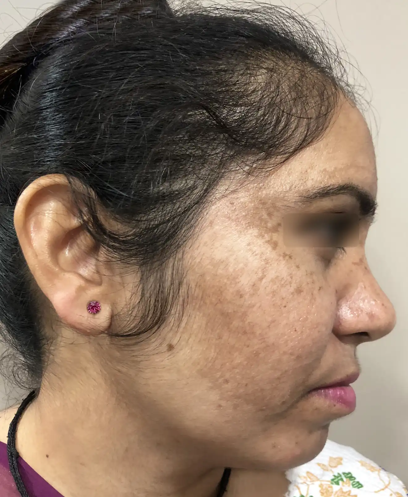 Female patient with facial melasma before treatment showing brown to dark-brown uneven pigmentation patches on cheeks and temple area.