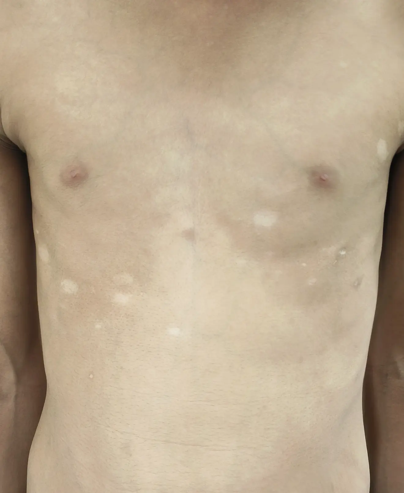 Here are SEO-optimized, AI-friendly image alt texts for both Before and After images in English and Hindi.  ✅ 1️⃣ Before Treatment – English Alt Text  Alt Text (English – Before): Male patient with vitiligo (white patches) on chest and upper trunk before treatment, showing well-defined depigmented milky-white patches with clear margins.