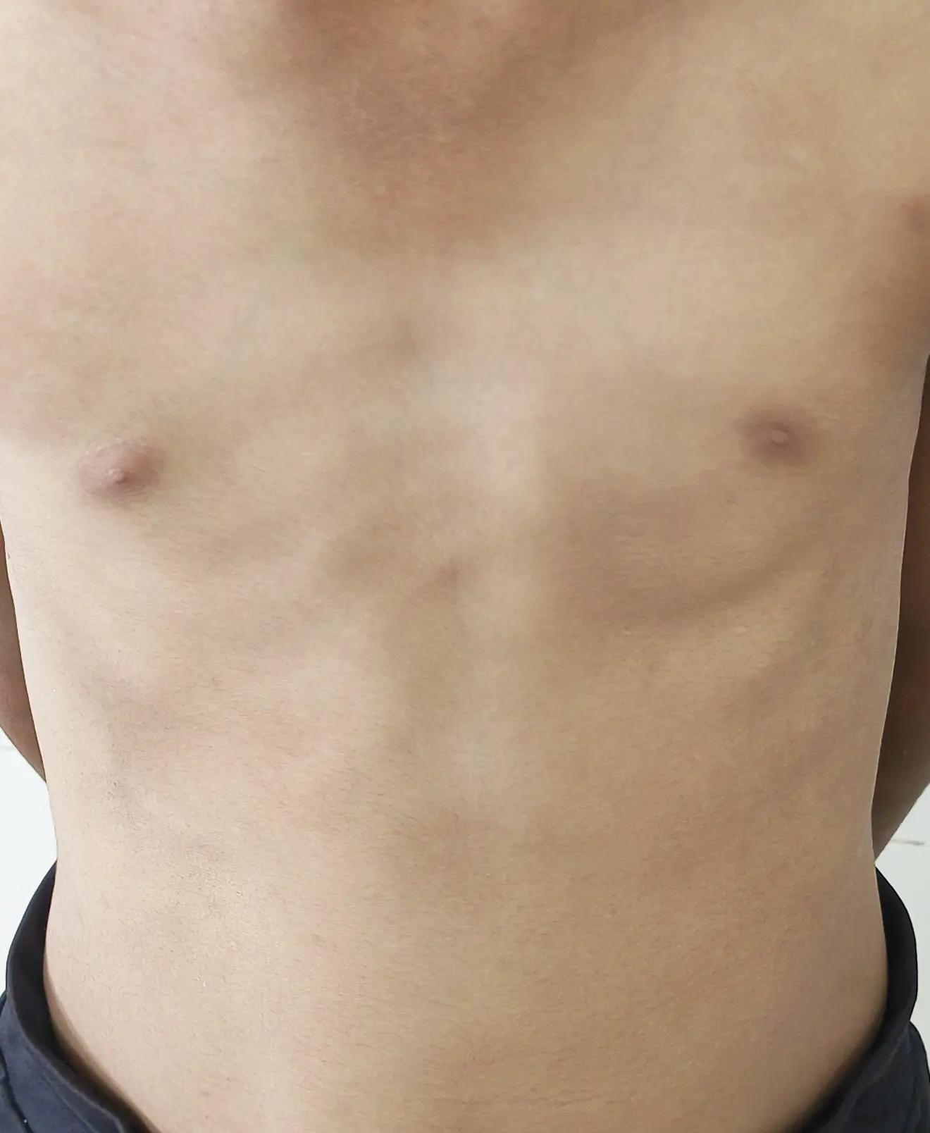Male vitiligo patient chest before and after treatment comparison showing visible repigmentation and reduced contrast of white patches after dermatological therapy.
