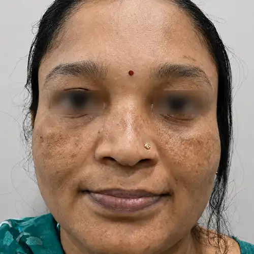 Before Online Melasma Treatment on Face - Dark Brown Pigmentation on Cheeks and Nose