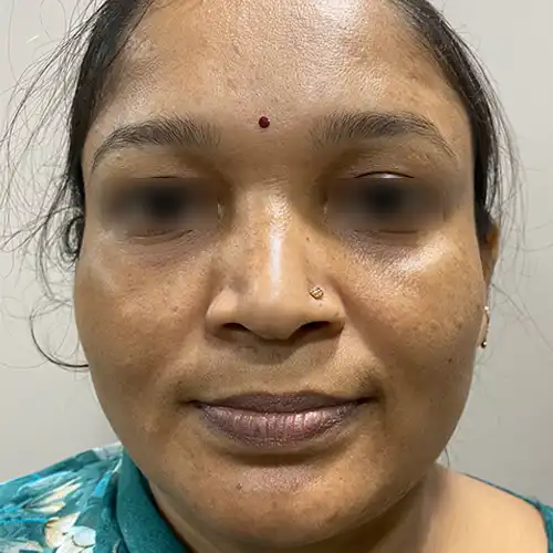After Online Melasma Treatment on Face - Visible Improvement in Facial Pigmentation and Skin Tone