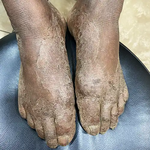 Before online eczema treatment - dry, thickened, scaly and rough skin on both feet and ankles