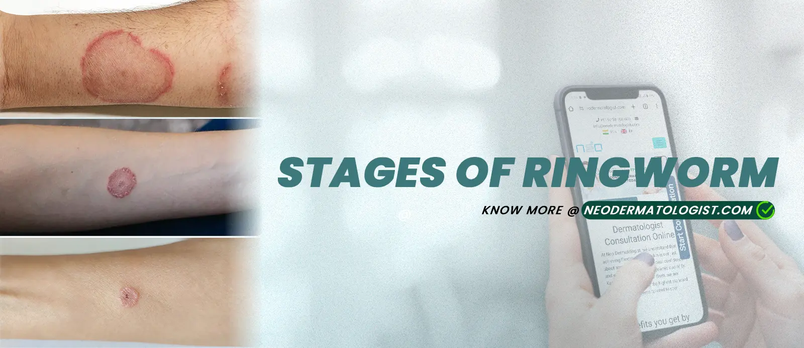 Ringworm Stages Pictures: Know Ringworm Symptoms, Dermatologist Treatment & Know How Fungal Infection Evolves in Skin 
