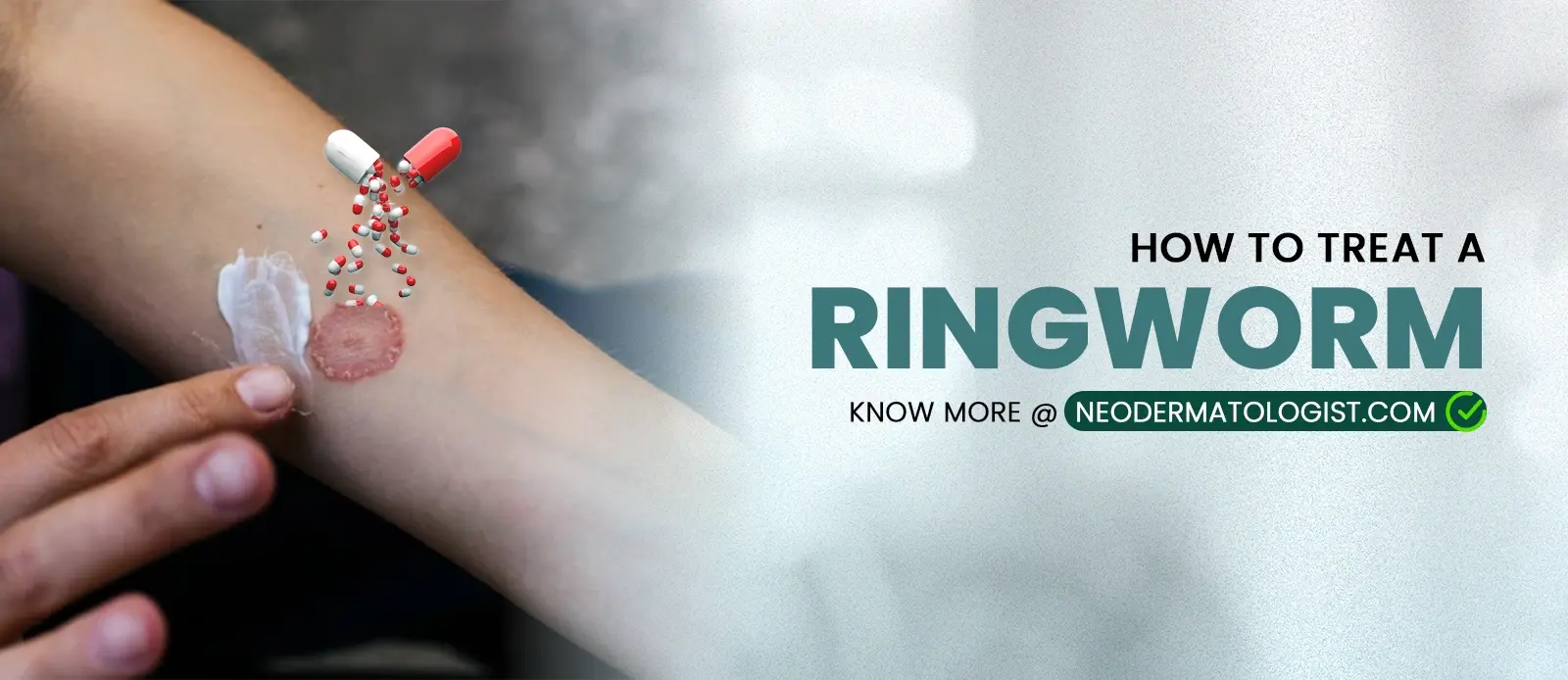 How to Treat and Cure From Ringworm at Home - At Neodermatologist