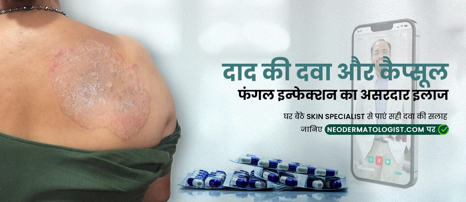 दाद की दवा और कैप्सूल: फंगल इन्फेक्शन का असरदार इलाज