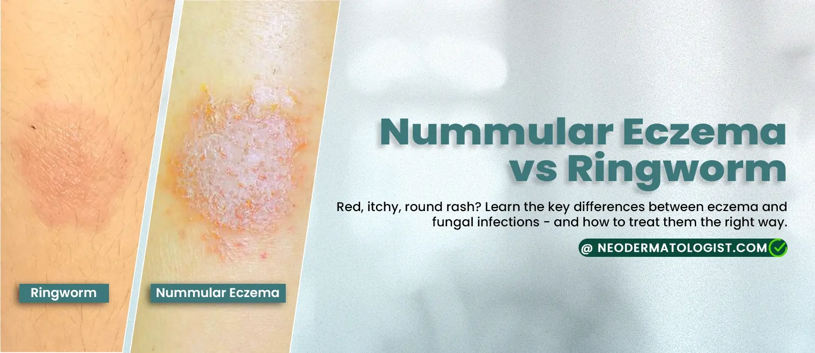 Nummular Eczema  and  Ringworm Difference - Get Expert Dermatologist Advice Today at Neodermatologist - Online Dermatology Consultation