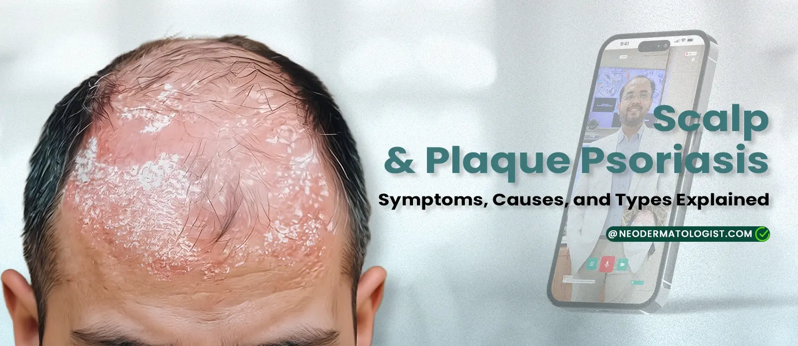 स्कैल्प और प्लाक सोरायसिस: प्रकार, कारण और लक्षण - NeoDermatologist द्वारा साझा किया गया | घर बैठे ऑनलाइन सोरायसिस उपचार प्राप्त करें