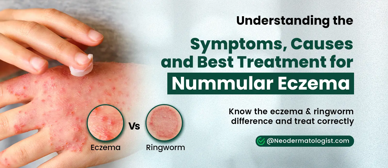 Understanding the Symptoms, Causes, and Best Treatment for Nummular Eczema - Guide By Neodermatologist