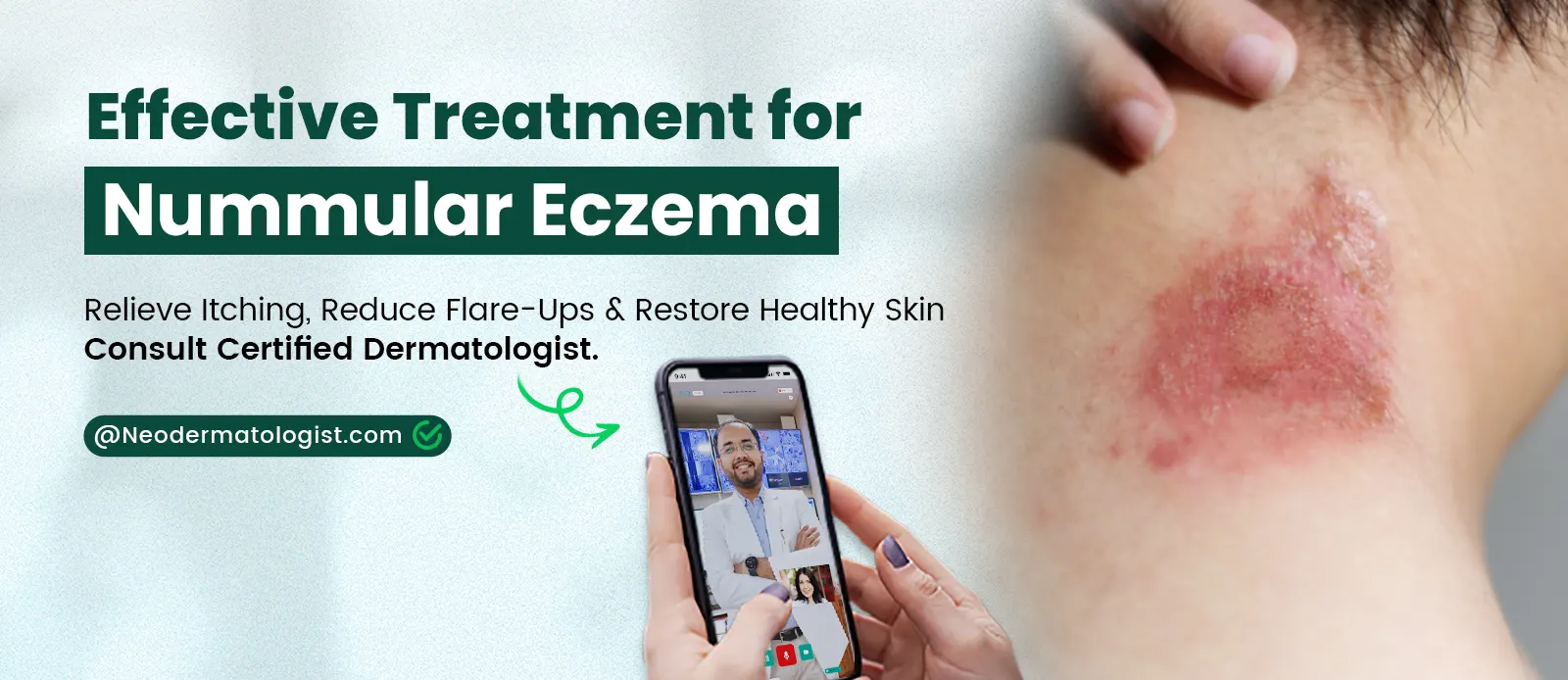 Effective Treatment For Nummular Eczema Vs Ringworm 