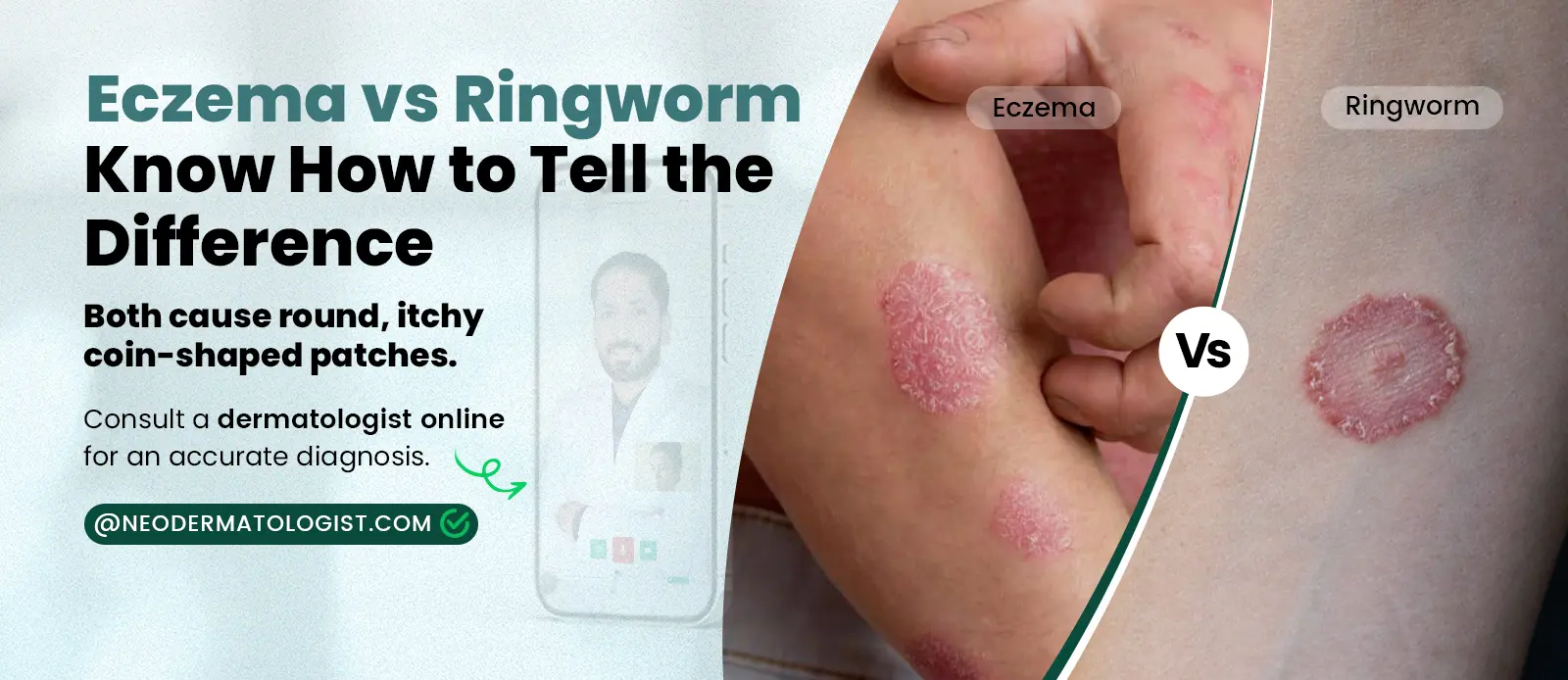  Eczema vs Ringworm: Know How to Tell the Difference Expert Guide By Certified Dermatologist At Neodermatologist
