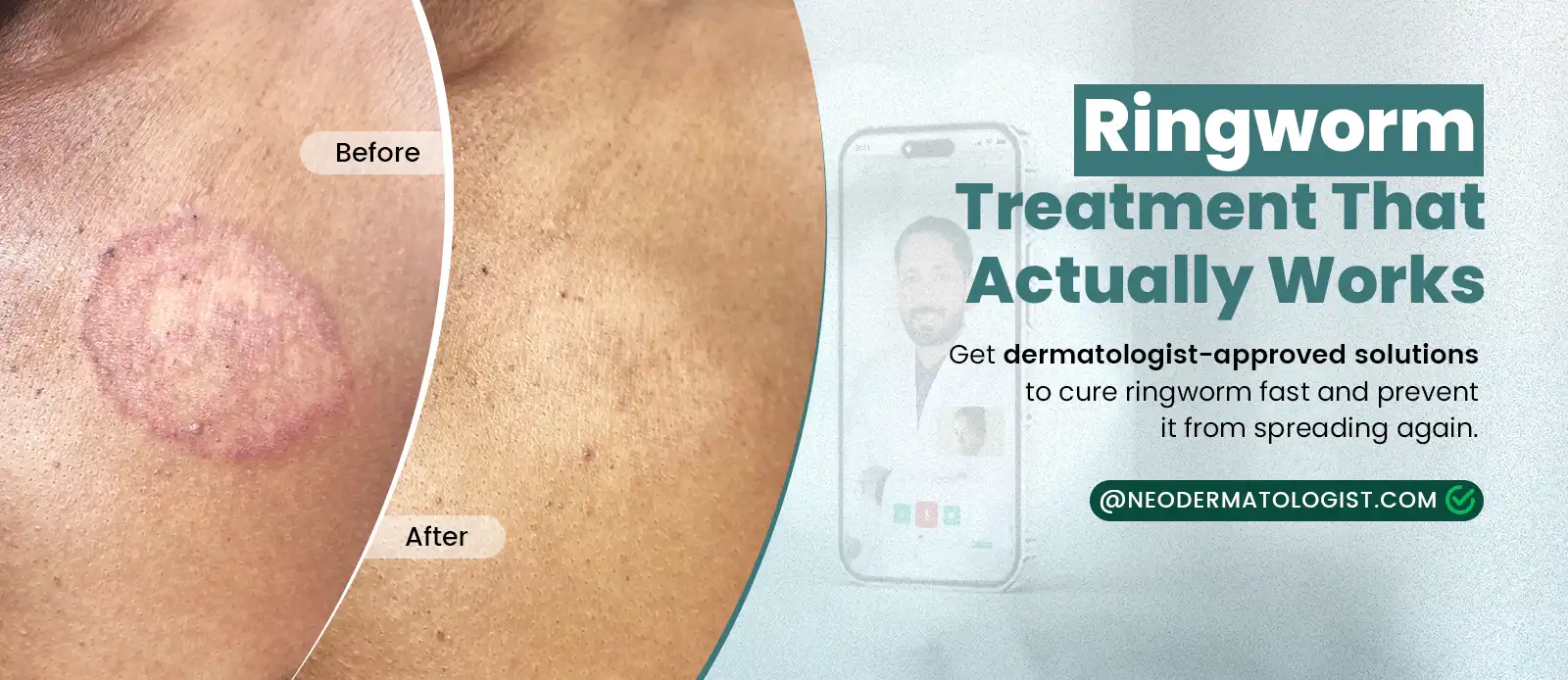 Certified dermatologist recommended ringworm treatment that works well at Neodermatologist