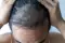 dandruff treatment, hair fall control , hair loss treatment , hair loss treatment for men, hair loss treatment for women , alopecia areata treatment , Hair Fall Treatment , head lice treatment , thin hair treatments , hair fall doctor near me , hair fall 