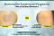 Nummular eczema vs ringworm - coin shaped eczema rash treated with dermatology care - effective treatment for nummular eczema vs ringworm through online dermatologist neodermatologist.com