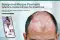 Scalp and Plaque Psoriasis: Symptoms, Causes, and Types of psoriasis by Neodermatologist, Scalp Psoriasis symptoms, Plaque Psoriasis  symptoms