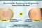 Nummular eczema vs ringworm - coin shaped eczema rash treated with dermatology care - effective treatment for nummular eczema vs ringworm through online dermatologist neodermatologist.com