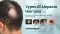 Know the types of alopecia hair loss and its causes - Know when to consult dermatologist online
