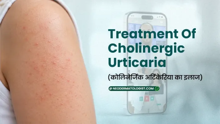 Treatment of Cholinergic Urticaria - Learn Symptoms, Causes & Online Treatment Guide By Neodermatologist