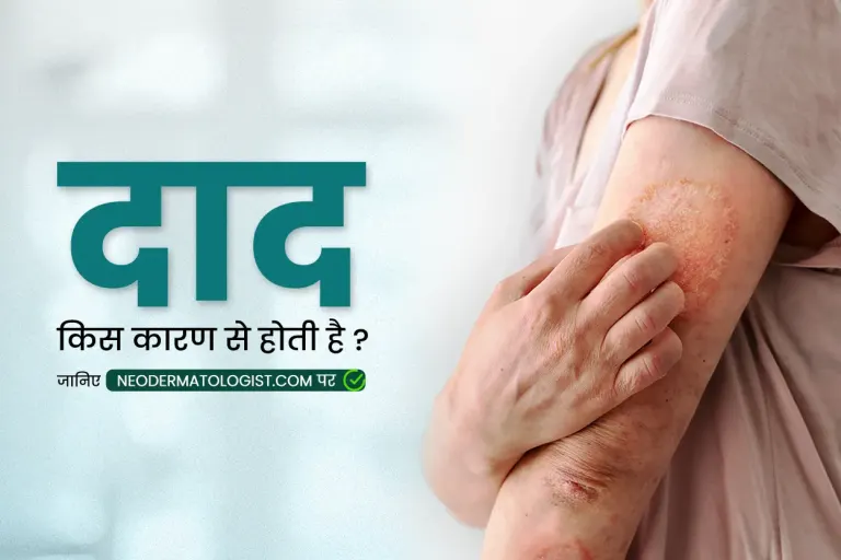 दाद के कारण  ( daad ka karan ), दाद होने का मुख्य कारण क्या है