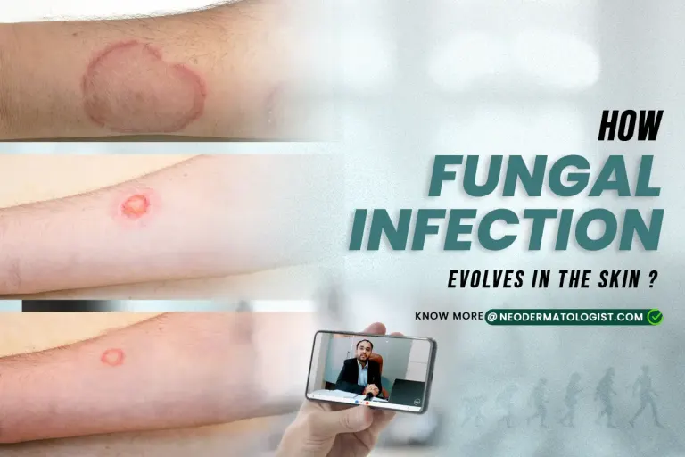दाद के चरण और उसके लक्षण, मनुष्यों में दाद (Ringworm) के लक्षण