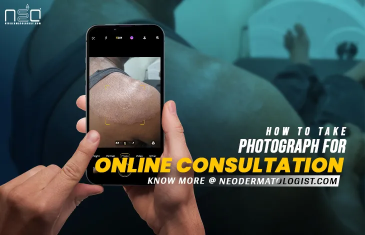 How To Take Photographs For Online Dermatologist Consultation - Important information about fungal infection images,  tinea corporis images ,   alopecia images,  pityriasis rosea images,  vitiligo images ,   eczema skin images ,    ringworm pictures of