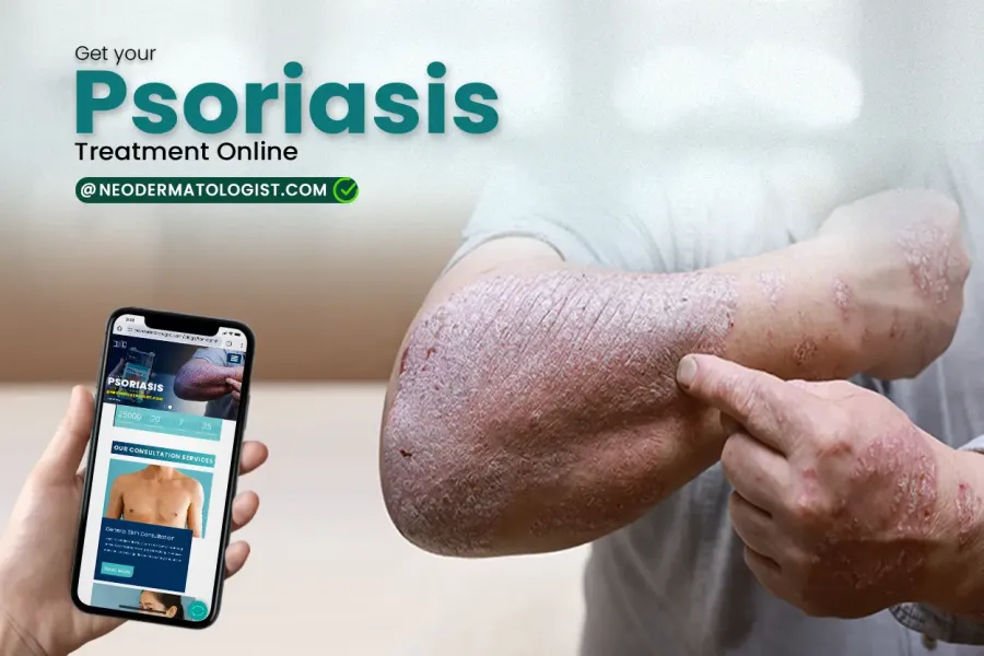 psoriasis treatment or psoriasis skin disease treatment