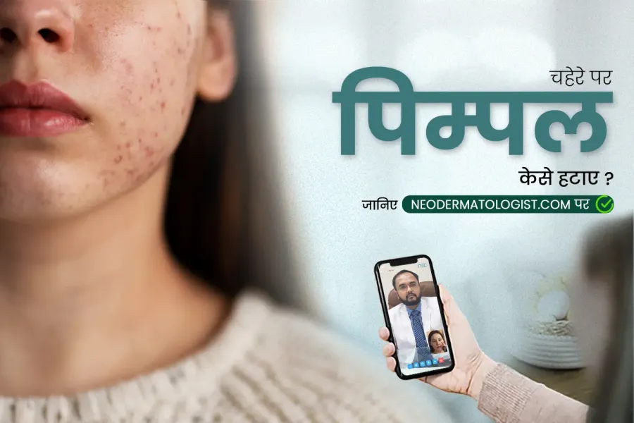 पिम्पल हटाने का तरीका,   face pe dane kaise hataye , पिंपल कैसे हटाए, pimple kaise hataye , pimple ke daag kaise hataye ,  chehre pe pimple kaise hataye ,  pimple ke kale daag kaise hataye ,   pimple hatane ke upay,