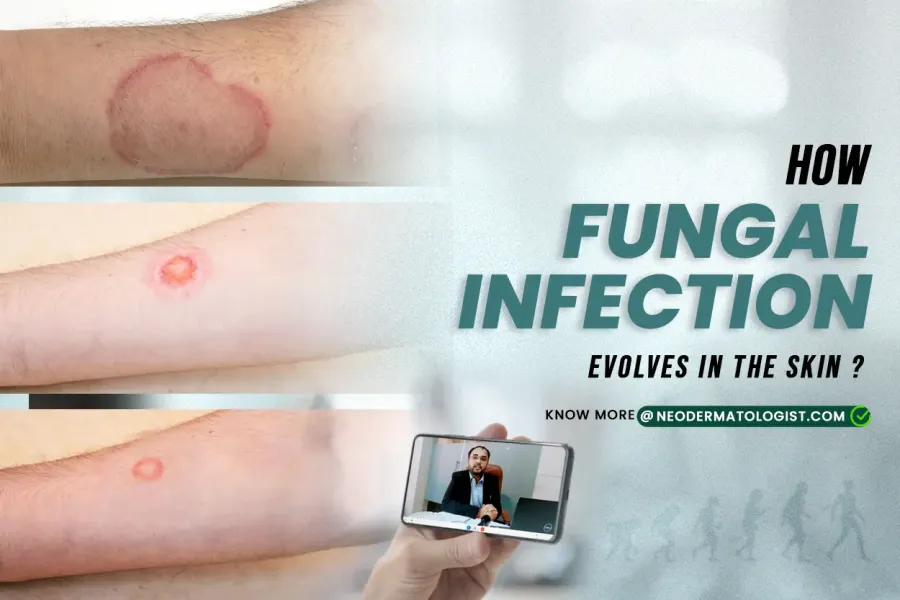 ringworm symptoms ,  ringworm on skin ,   jock itch rash , ringworm stages , ringworm disease , ringworm symptoms in humans , ringworm disease symptoms , fungal infection evolves in skin