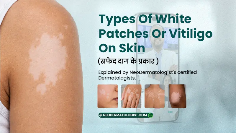 Types of white patches on skin, from focal to generalised vitiligo - explained by NeoDermatologist