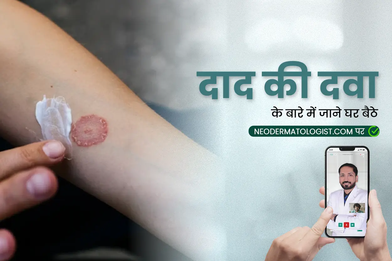 dad ki dawa.  दाद की दवा ,   दाद खाज खुजली की दवा क्रीम ,  दाद खुजली की दवाई, ring worm medicine, ring worm infection medicine, ring worm soap, ringworm treatment tablet, दाद की दवा कैप्सूल, दाद की मेडिसिन  क्रीम, दाद खाज की दवा