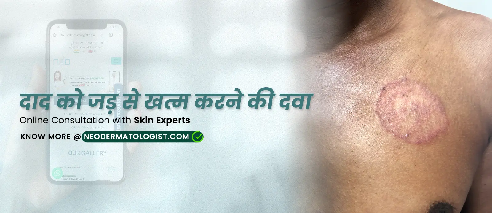 दाद को जड़ से खत्म करने की दवा – Online Consultation with Skin Experts