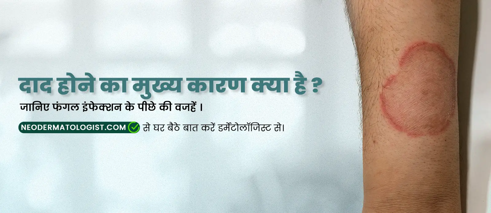 दाद होने का मुख्य कारण क्या है? दाद किसके कारण होती है, दाद किस कारण होता है, daad ka karan, dad khaj kaise hota hai, daad khaj khujli hone ka karan