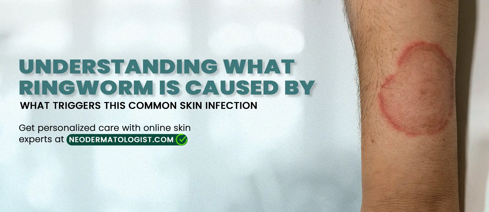 What Ringworm Is Caused By?  ringworm disease is caused by, what causes ringworm infection, how ringworm is caused, ringworm infection causes