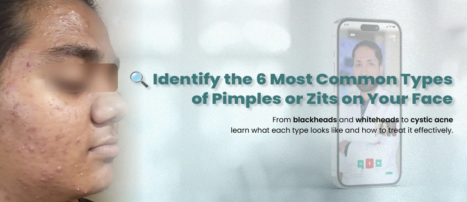 Common Types of Pimples or Zits on Your Face