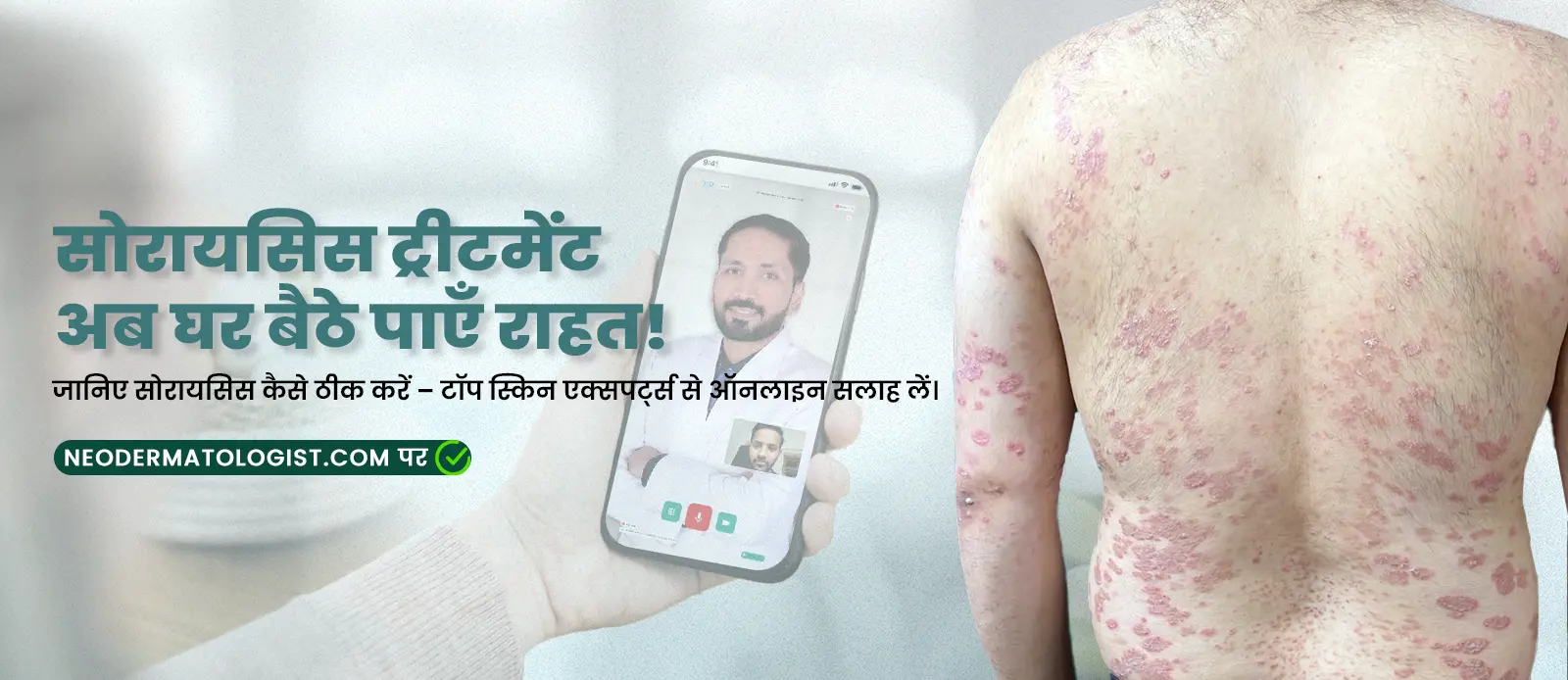सोरायसिस ट्रीटमेंट – जानिए सोरायसिस कैसे ठीक करें – टॉप स्किन एक्सपर्ट्स से ऑनलाइन सलाह लें।