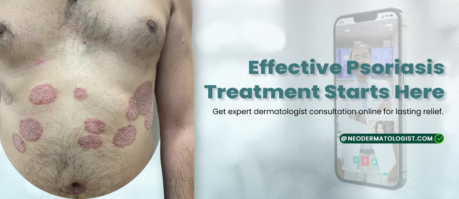 Effective Psoriasis Treatment  -  Get expert dermatologist consultation online