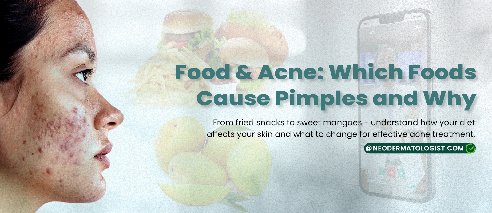 Food & Acne: Which Foods Cause Pimples - From fried snacks to sweet mangoes - understand how your diet affects your skin and what to change for effective acne treatment.