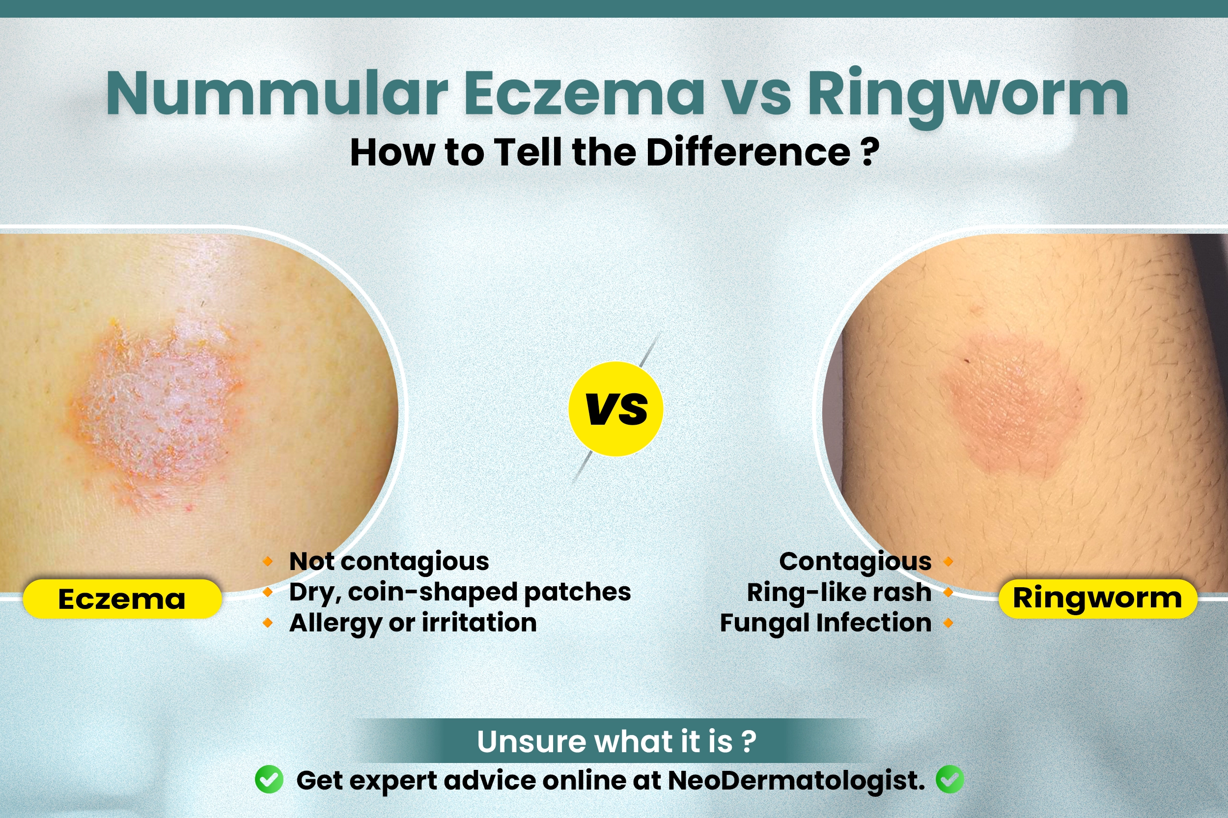 Nummular Eczema vs Ringworm (न्युम्युलर एक्जिमा और दाद में अंतर) - Know the differences, symptoms & treatment