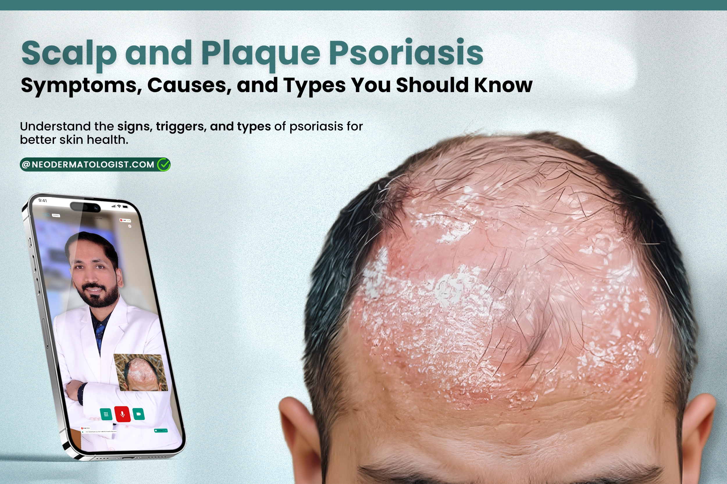 Scalp and Plaque Psoriasis Types, Causes, and Symptoms Shared By Neodermatologist
