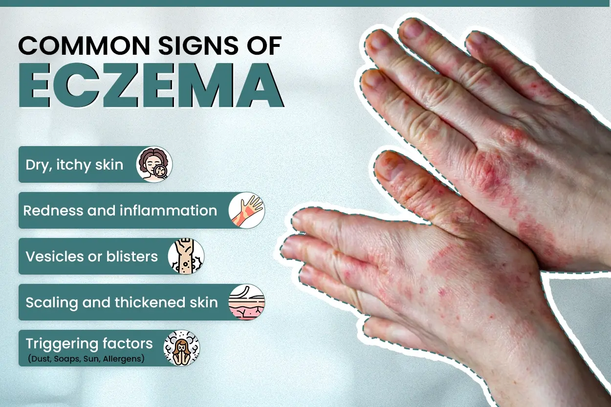 Understand Eczema - Its common sign, types, causes and symptoms, triggering factors