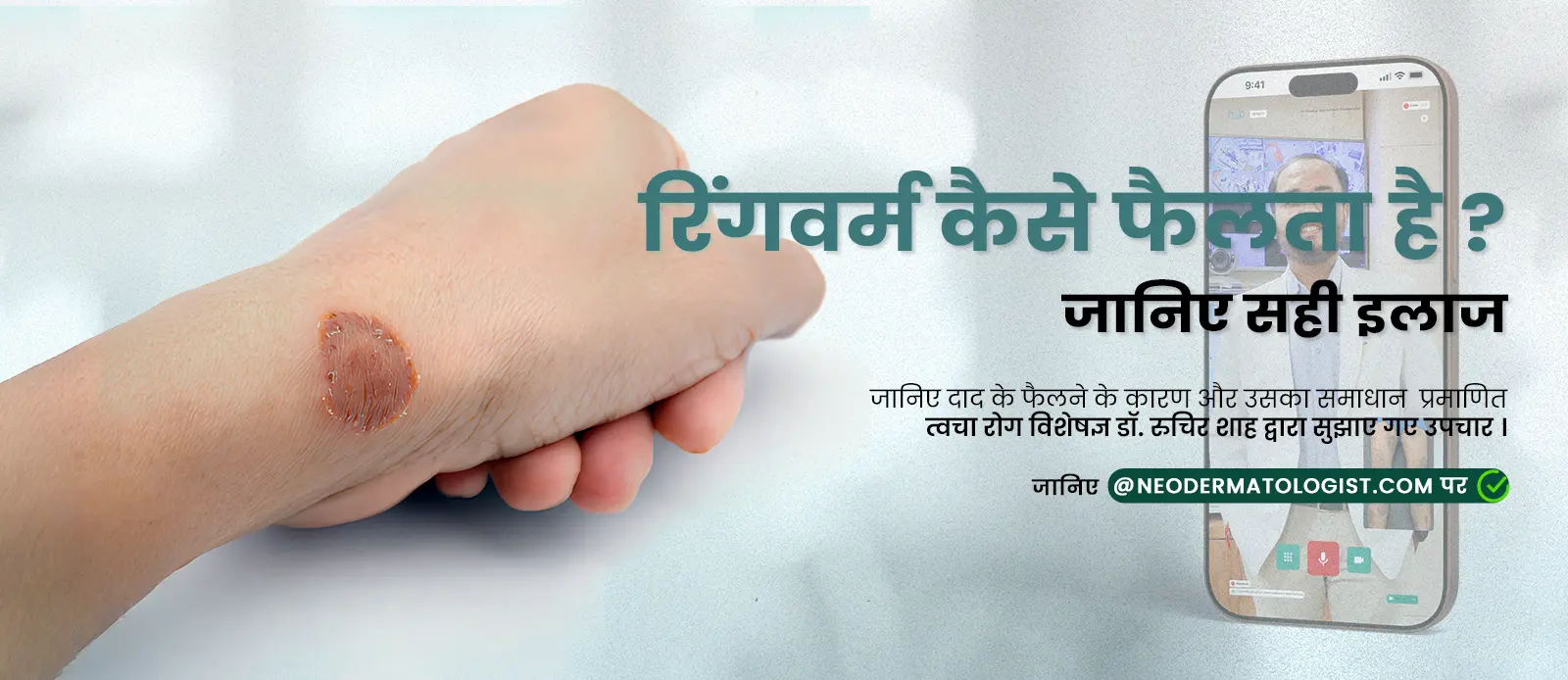 क्या रिंगवर्म (Daad)संक्रामक है - डॉ. रुचिर शाह और डॉ. कर्म पटेल से विशेषज्ञ उपचार प्राप्त करें, NeoDermatologist पर
