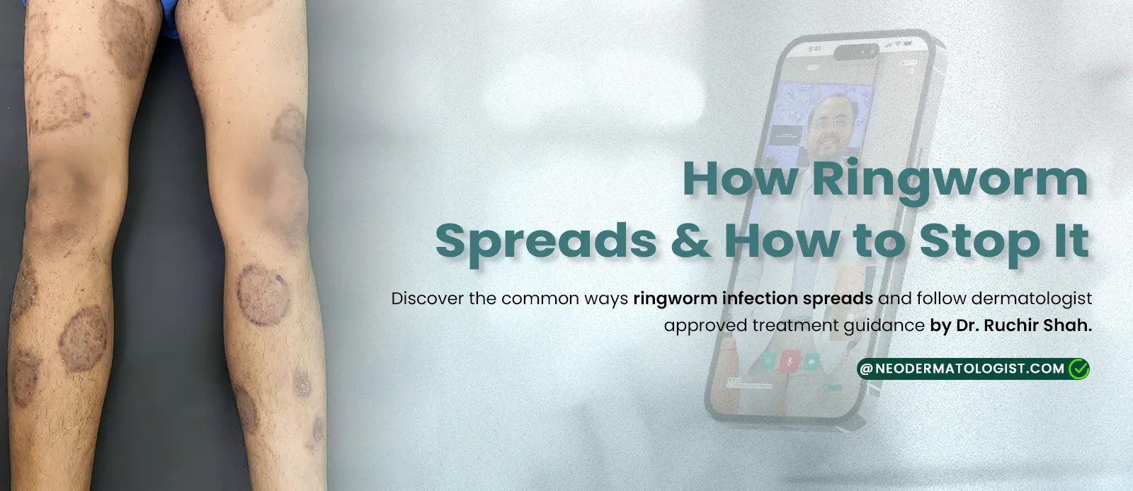 दाद (Daad - Ringworm) कैसे फैलती है और इसे कैसे रोका जाए - डर्मेटोलॉजिस्ट से विशेषज्ञ उपचार NeoDermatologist पर - डॉ. रुचिर शाह द्वारा