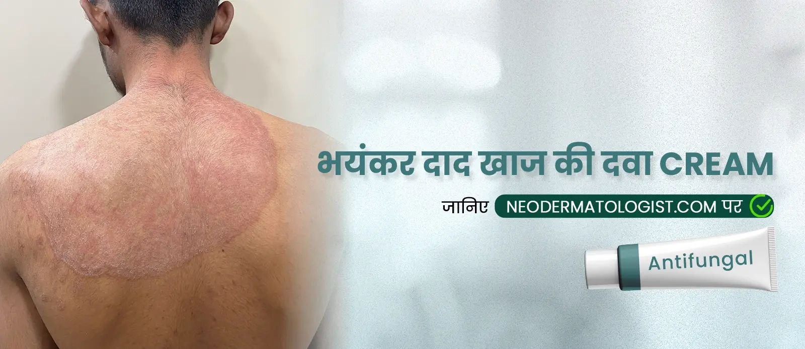 दाद का इलाज कैसे करें: जानिए भयंकर दाद खाज की दवा Cream