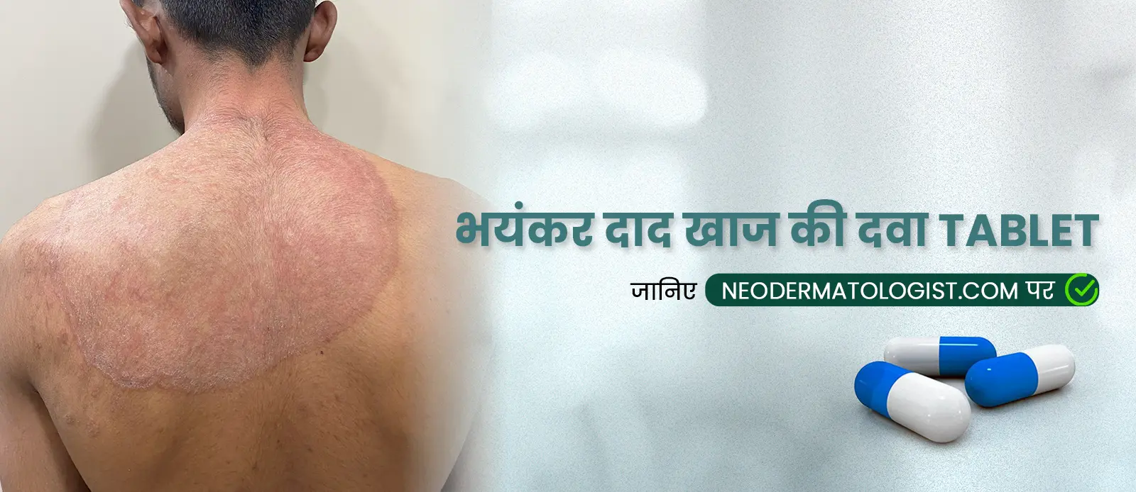 दाद का इलाज कैसे करें: जानिए भयंकर दाद खाज की दवा TABLET at Neodermatologist