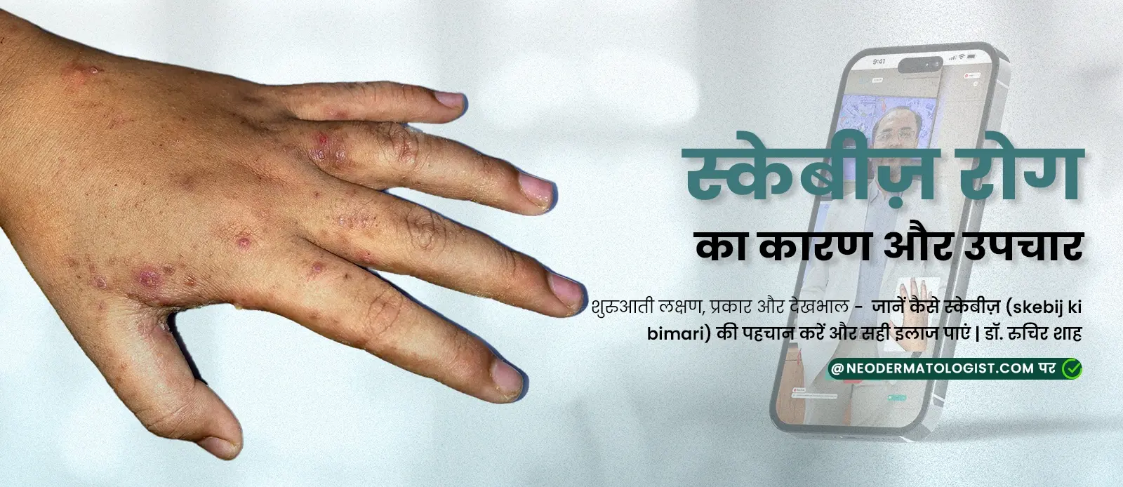 स्केबीज़ रोग का कारण और उपचार - शुरुआती लक्षण, प्रकार और देखभाल - जानें कैसे स्केबीज़ (skebij ki bimari) की पहचान करें और सही इलाज पाएं 