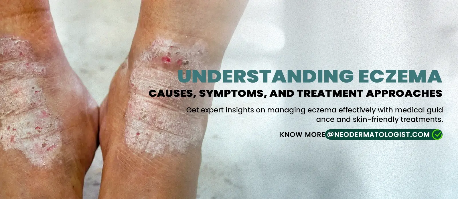 एक्जिमा को समझें: कारण, लक्षण और ऑनलाइन एक्जिमा उपचार के तरीके