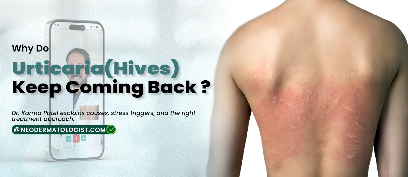 Causes of hives - Know the causes and treatment of urticaria by a certified dermatologist 