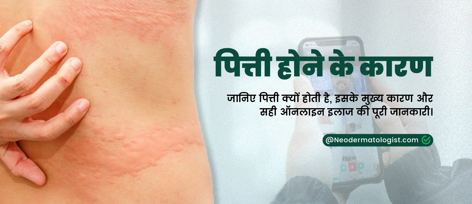 Causes of Urticaria Rash Causes - Know Why Urticaria or Hives Happens and How To Treat Hives Online From a Certified Dermatologist