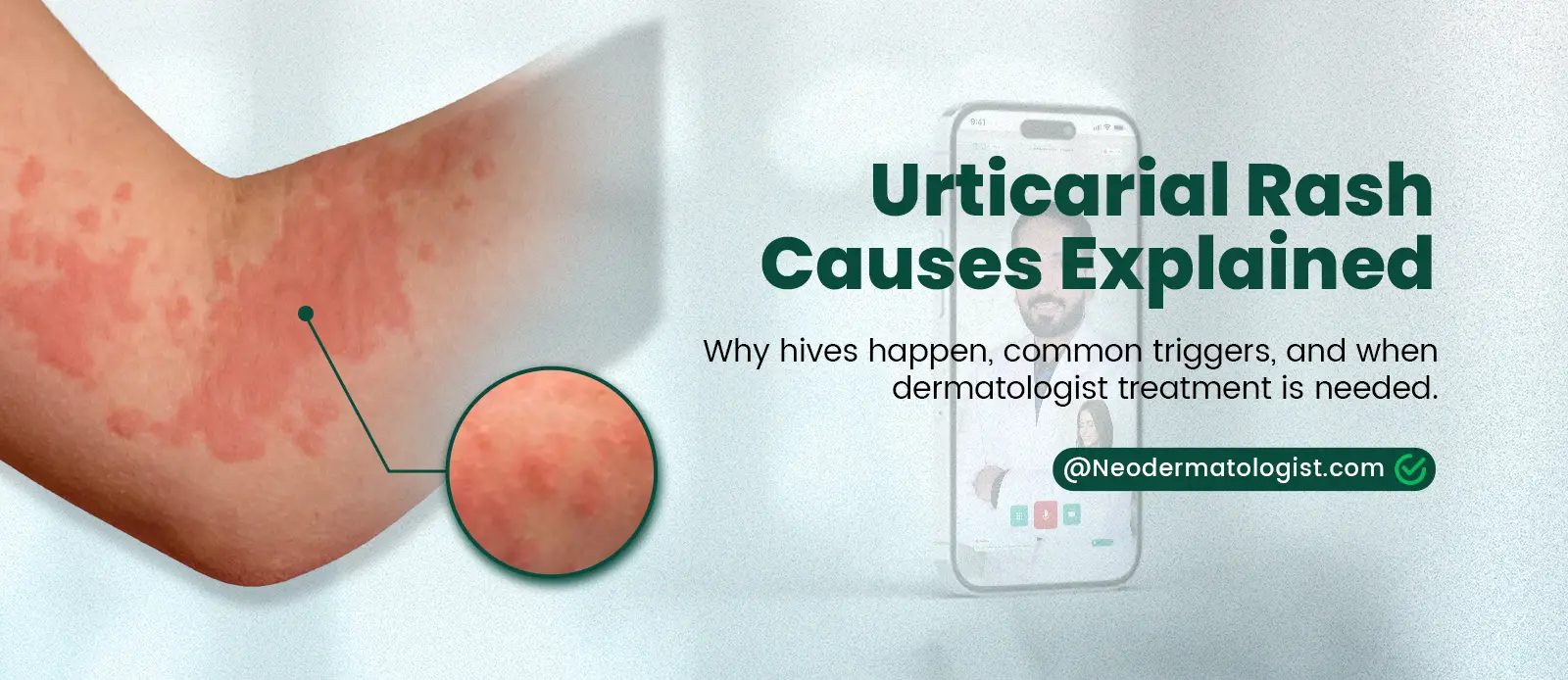 Urticarial Rash Causes - Get Urticaria Treatment Online By Certified Dermatologist at Neodermatologist.com
