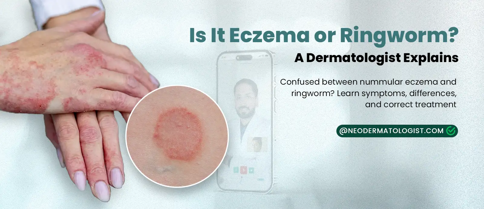 Is It Eczema or Ringworm? A Dermatologist Explains - Certified dermatologist of Neodermatologist